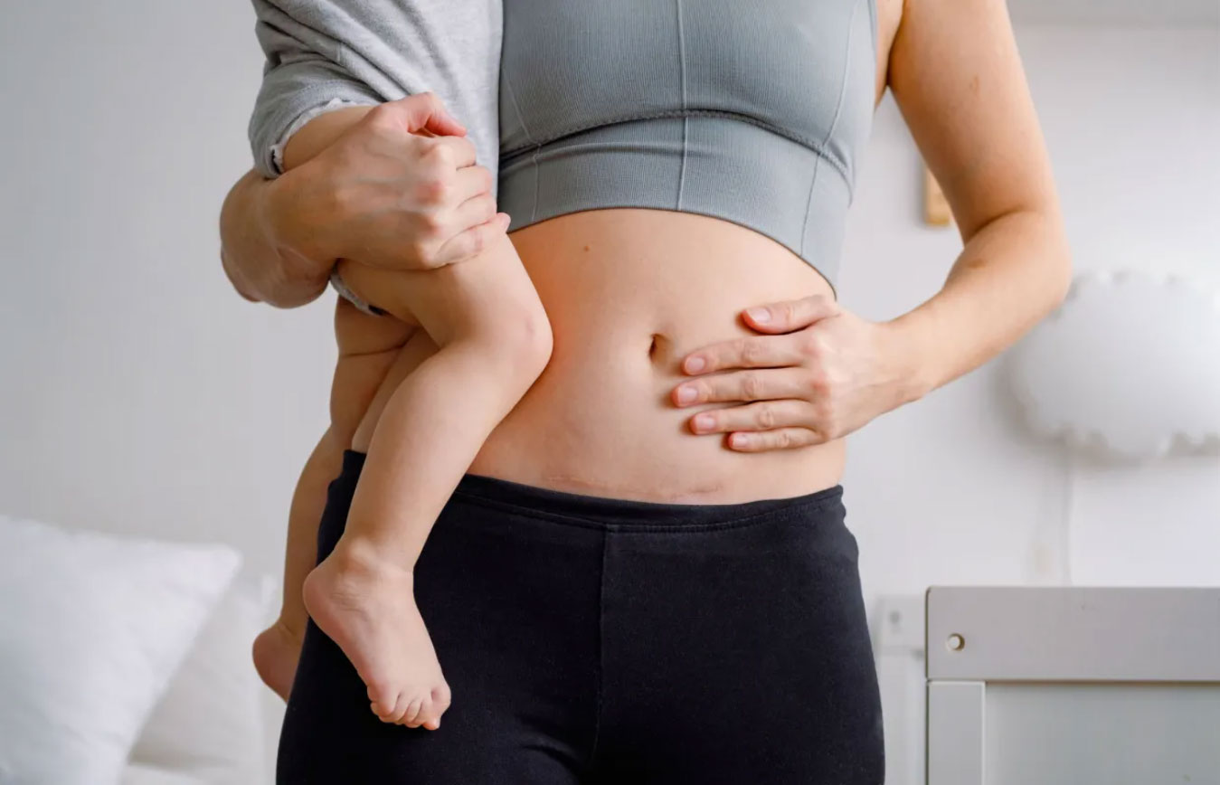 How to tell if you have muscle separation post-pregnancy?