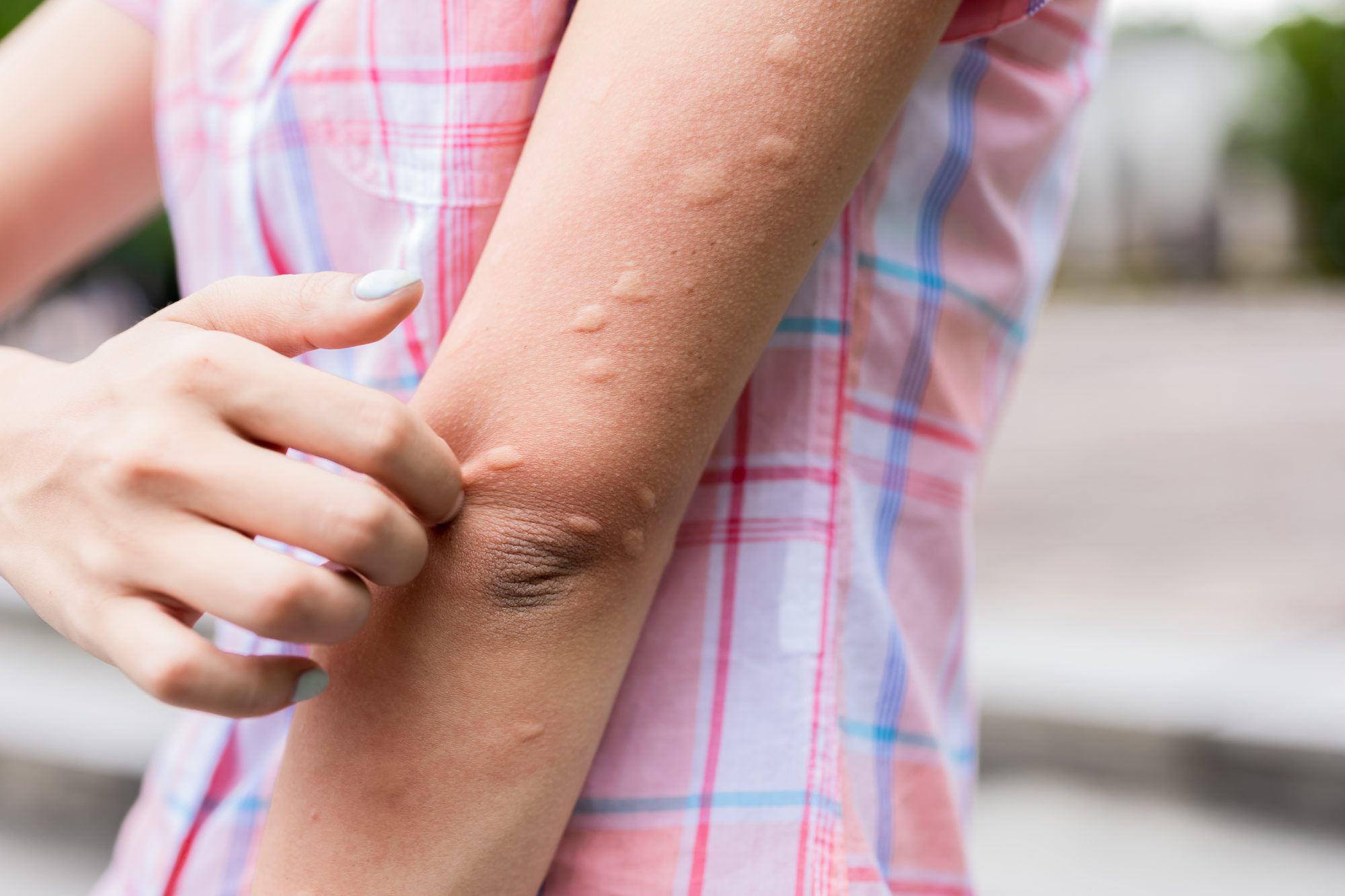 What Does an Allergic Reaction Heat Rash Look Like?