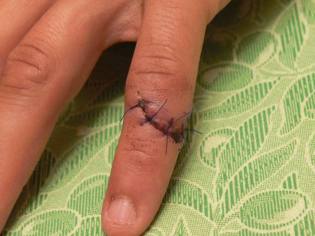 Laceration Care: How to Treat a Deep Cut Without Stitches